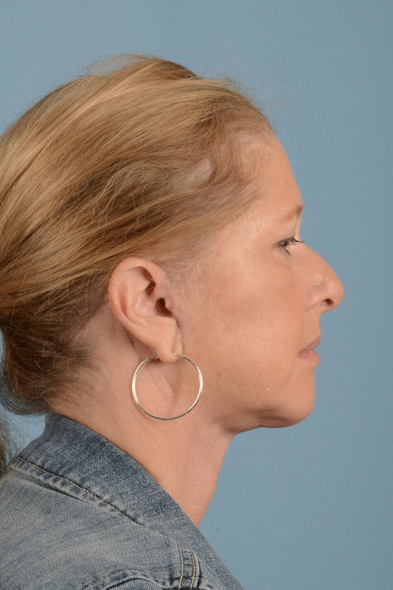 Facelift Before & After Gallery - Patient 346907 - Image 6