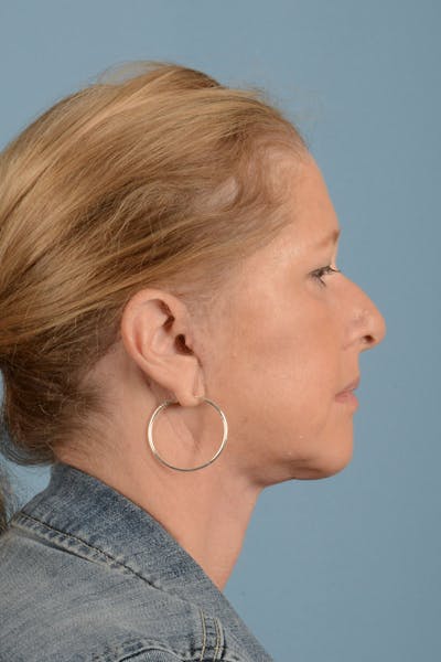 Facelift Before & After Gallery - Patient 346907 - Image 6