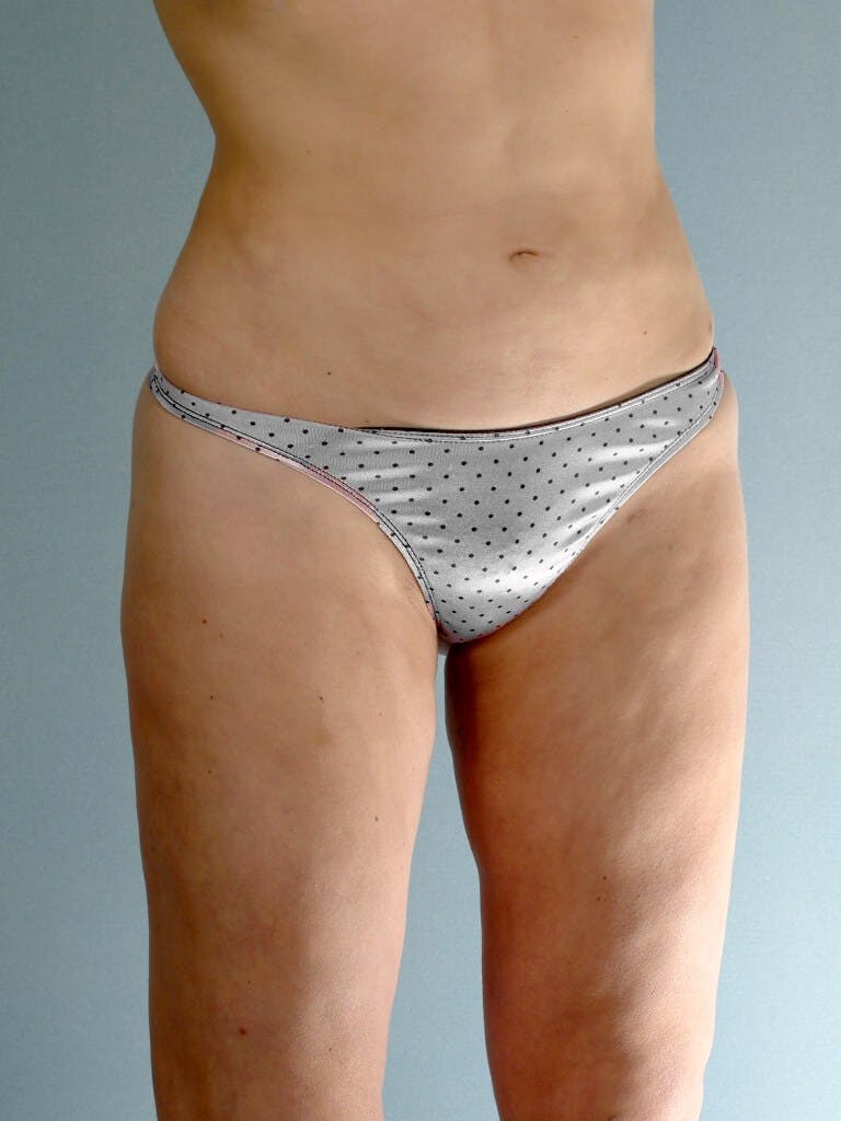 Liposuction Before & After Gallery - Patient 161150 - Image 4
