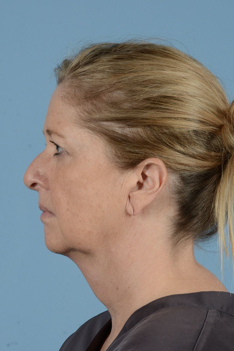 Facelift Before & After Gallery - Patient 346907 - Image 7