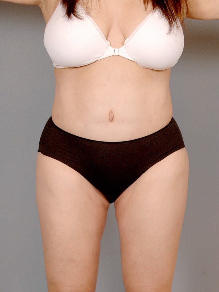 Tummy Tuck Before & After Gallery - Patient 236811 - Image 2