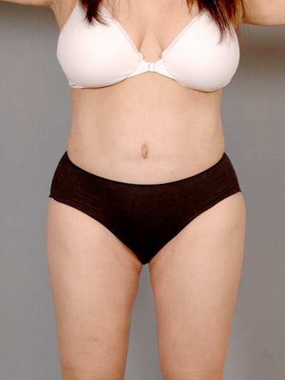 Tummy Tuck Before & After Gallery - Patient 236811 - Image 2