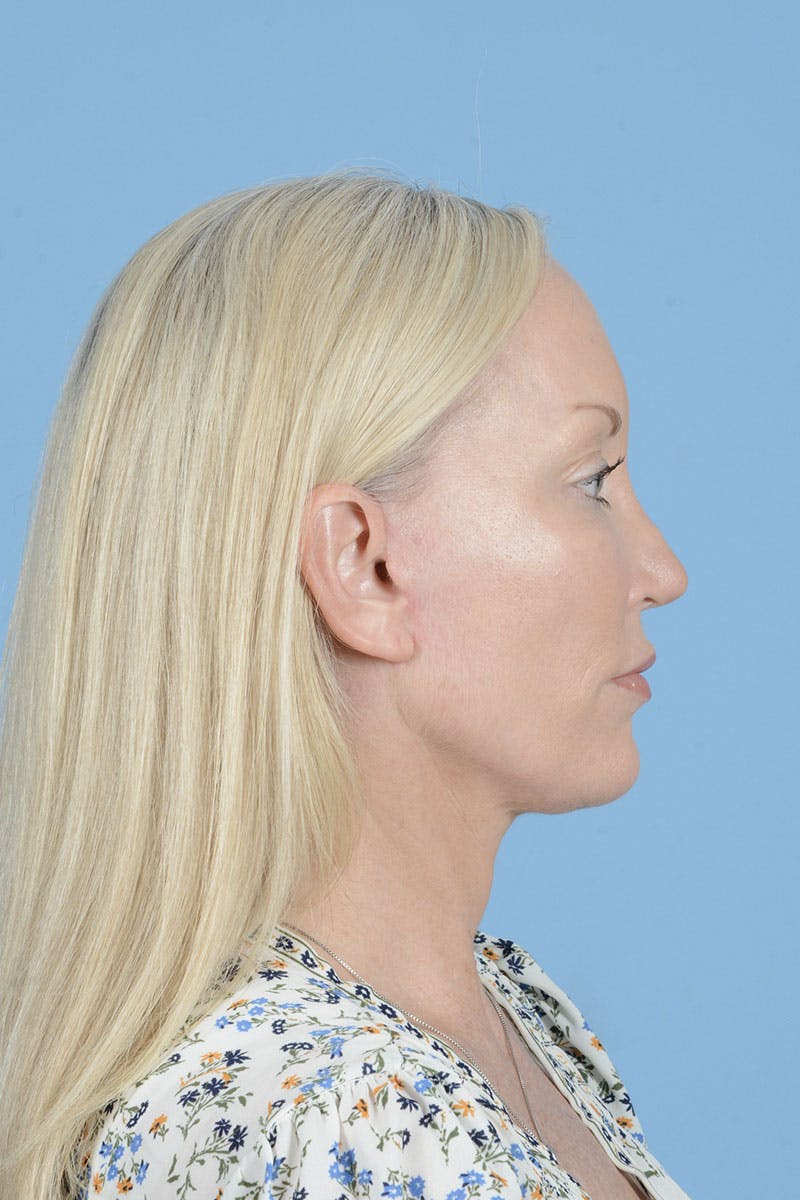 Neck Lift Before & After Gallery - Patient 311092 - Image 10