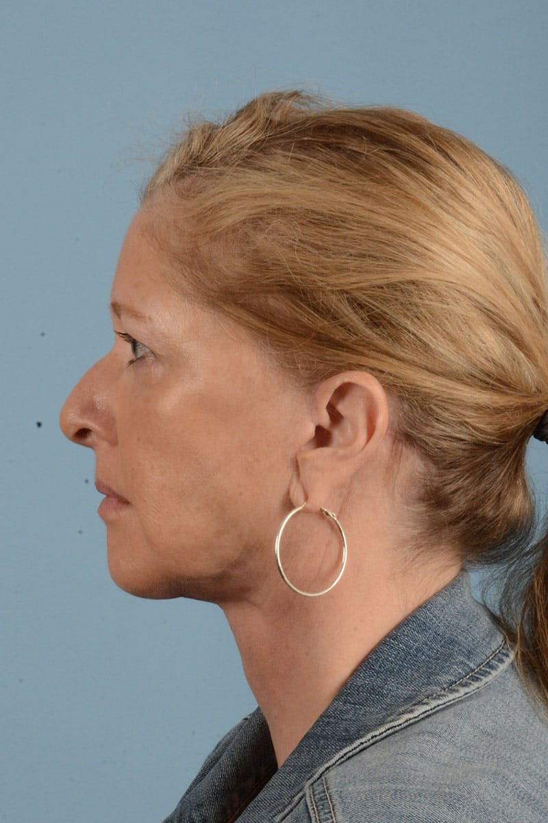 Facelift Before & After Gallery - Patient 346907 - Image 8