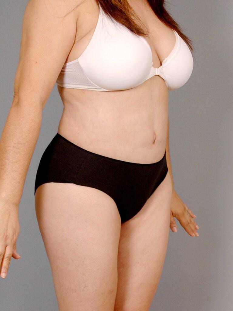 Tummy Tuck Before & After Gallery - Patient 236811 - Image 4