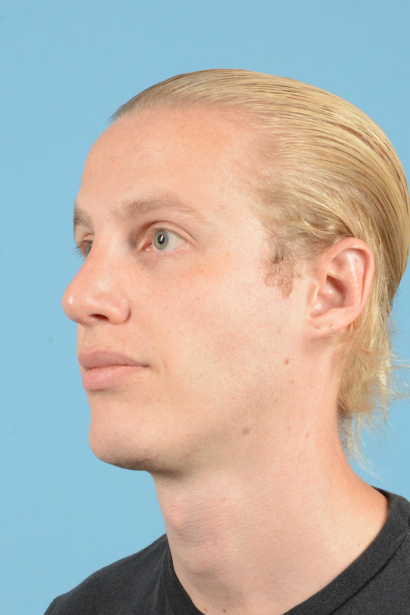 Rhinoplasty Before & After Gallery - Patient 270798 - Image 8