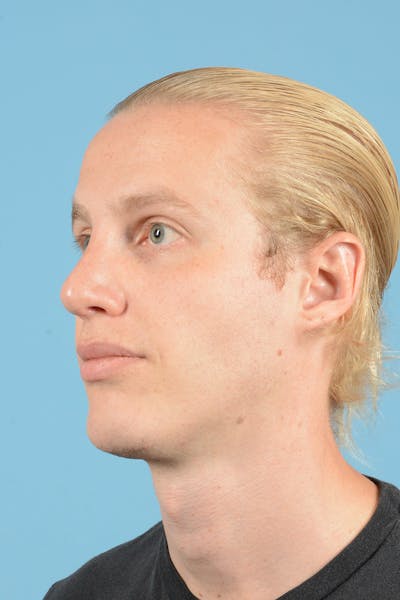 Rhinoplasty Before & After Gallery - Patient 270798 - Image 8