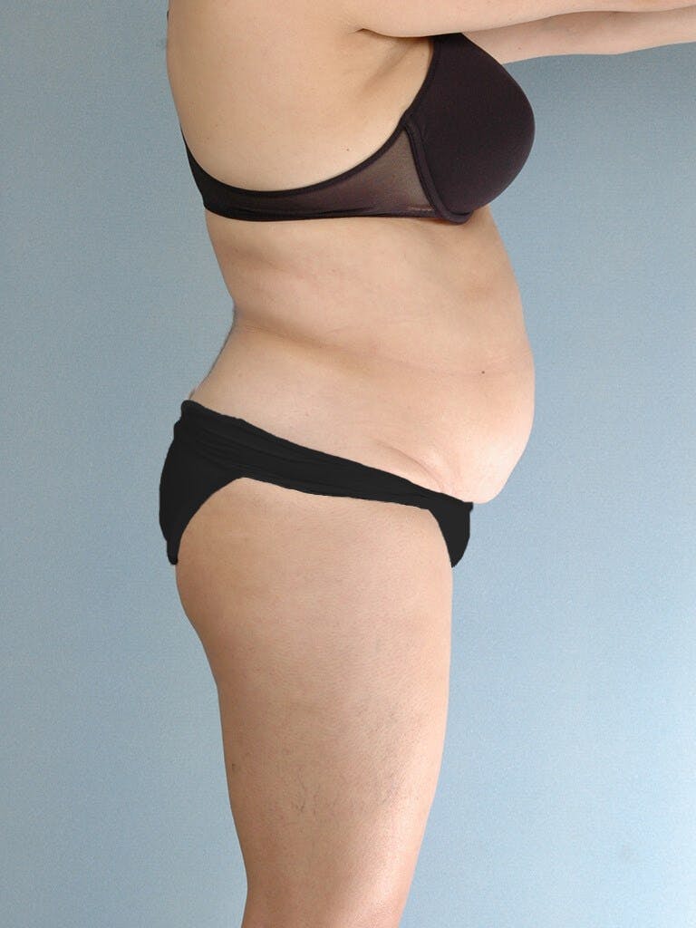 Tummy Tuck Before & After Gallery - Patient 236811 - Image 5
