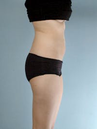 Liposuction Before & After Gallery - Patient 284768 - Image 1