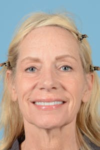Facelift Before & After Gallery - Patient 384471 - Image 1