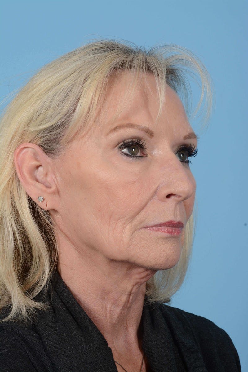 Chemical Peels Before & After Gallery - Patient 168224 - Image 3