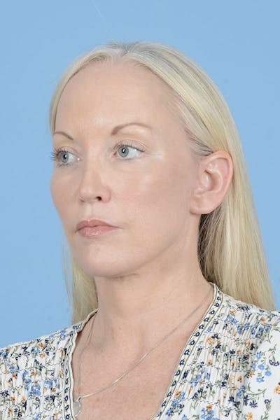 Neck Lift Before & After Gallery - Patient 311092 - Image 12