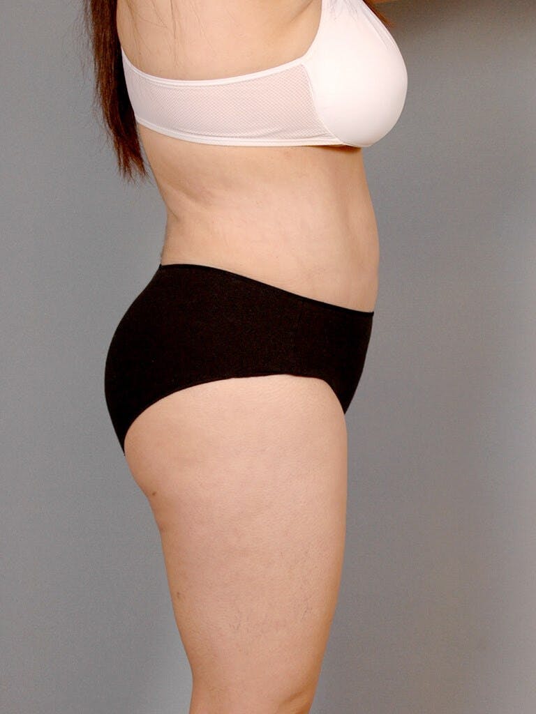 Tummy Tuck Before & After Gallery - Patient 236811 - Image 6