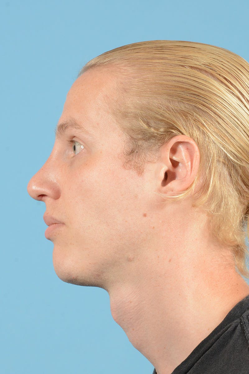 Rhinoplasty Before & After Gallery - Patient 270798 - Image 10