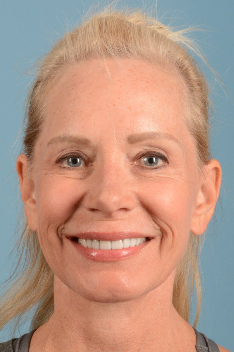 Facelift Before & After Gallery - Patient 384471 - Image 2