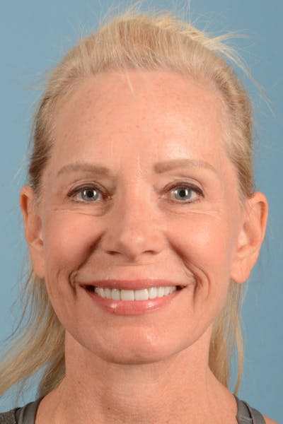 Facelift Before & After Gallery - Patient 384471 - Image 2