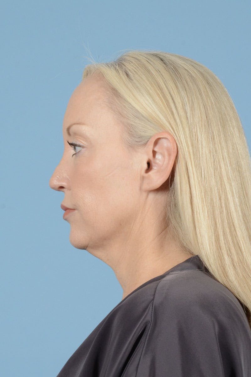 Neck Lift Before & After Gallery - Patient 311092 - Image 13