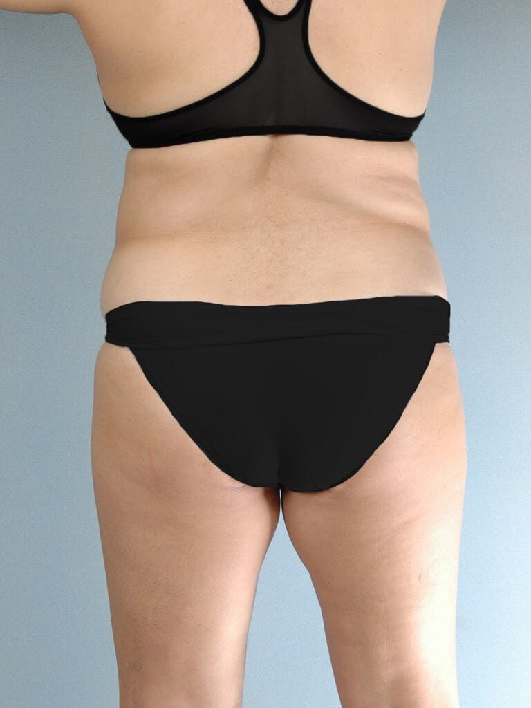 Tummy Tuck Before & After Gallery - Patient 236811 - Image 7
