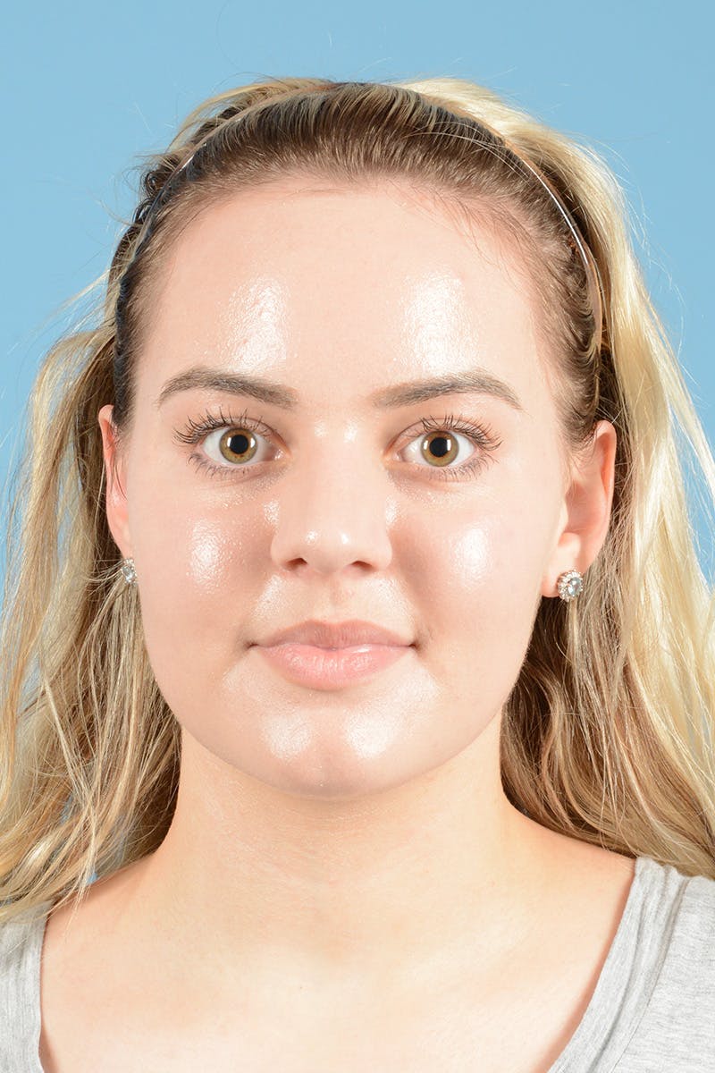 Rhinoplasty Before & After Gallery - Patient 214706 - Image 1
