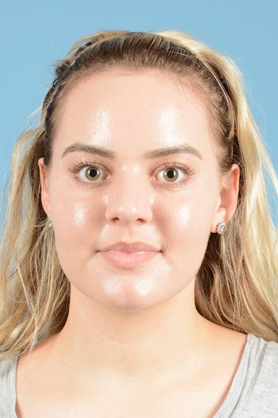 Rhinoplasty Before & After Gallery - Patient 214706 - Image 1