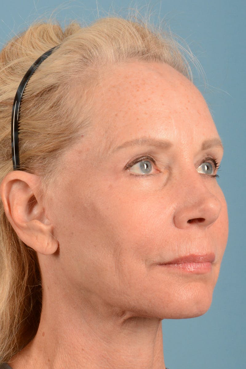 Facelift Before & After Gallery - Patient 384471 - Image 4