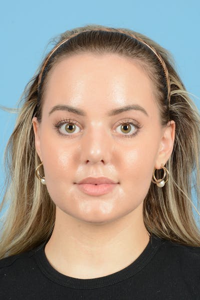 Rhinoplasty Before & After Gallery - Patient 214706 - Image 2