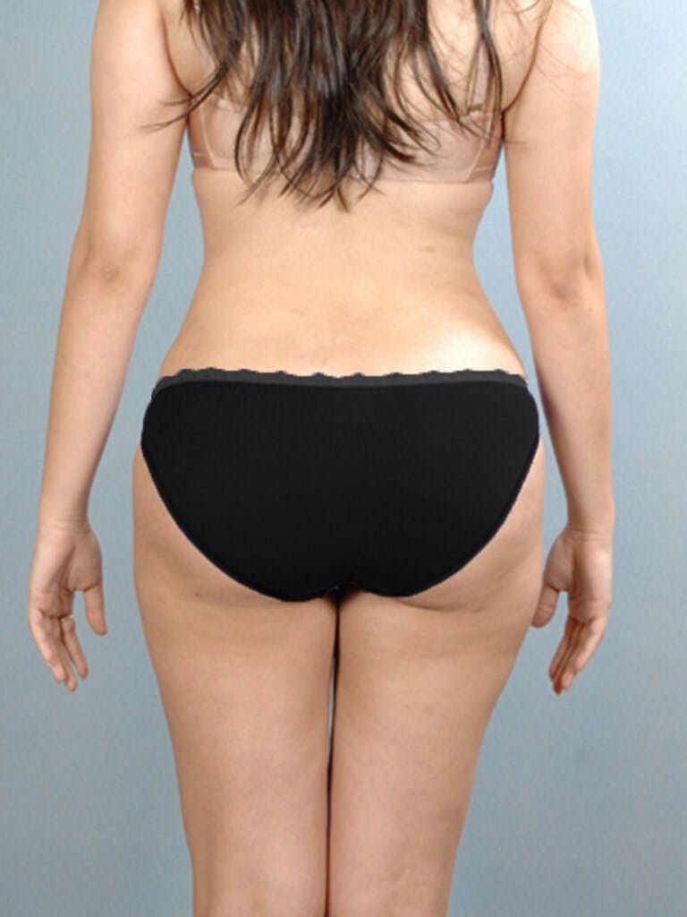 Liposuction Before & After Gallery - Patient 284768 - Image 6