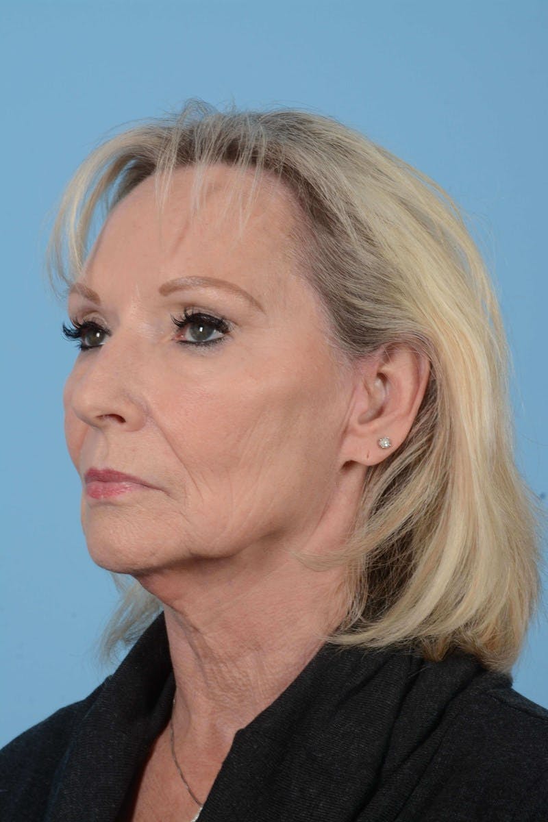 Chemical Peels Before & After Gallery - Patient 168224 - Image 7
