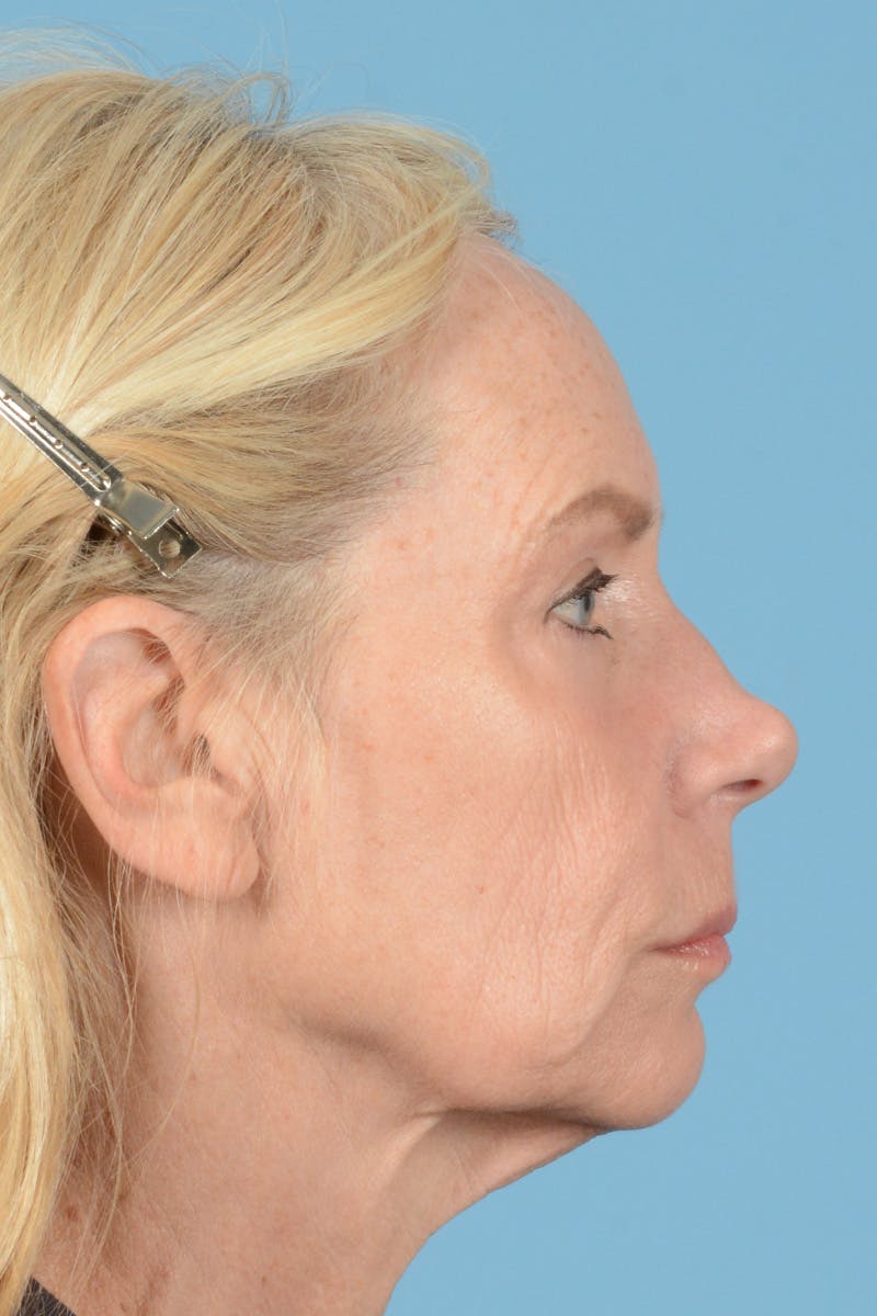 Facelift Before & After Gallery - Patient 384471 - Image 5