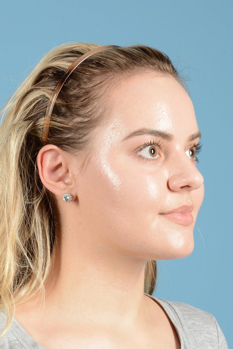 Rhinoplasty Before & After Gallery - Patient 214706 - Image 3