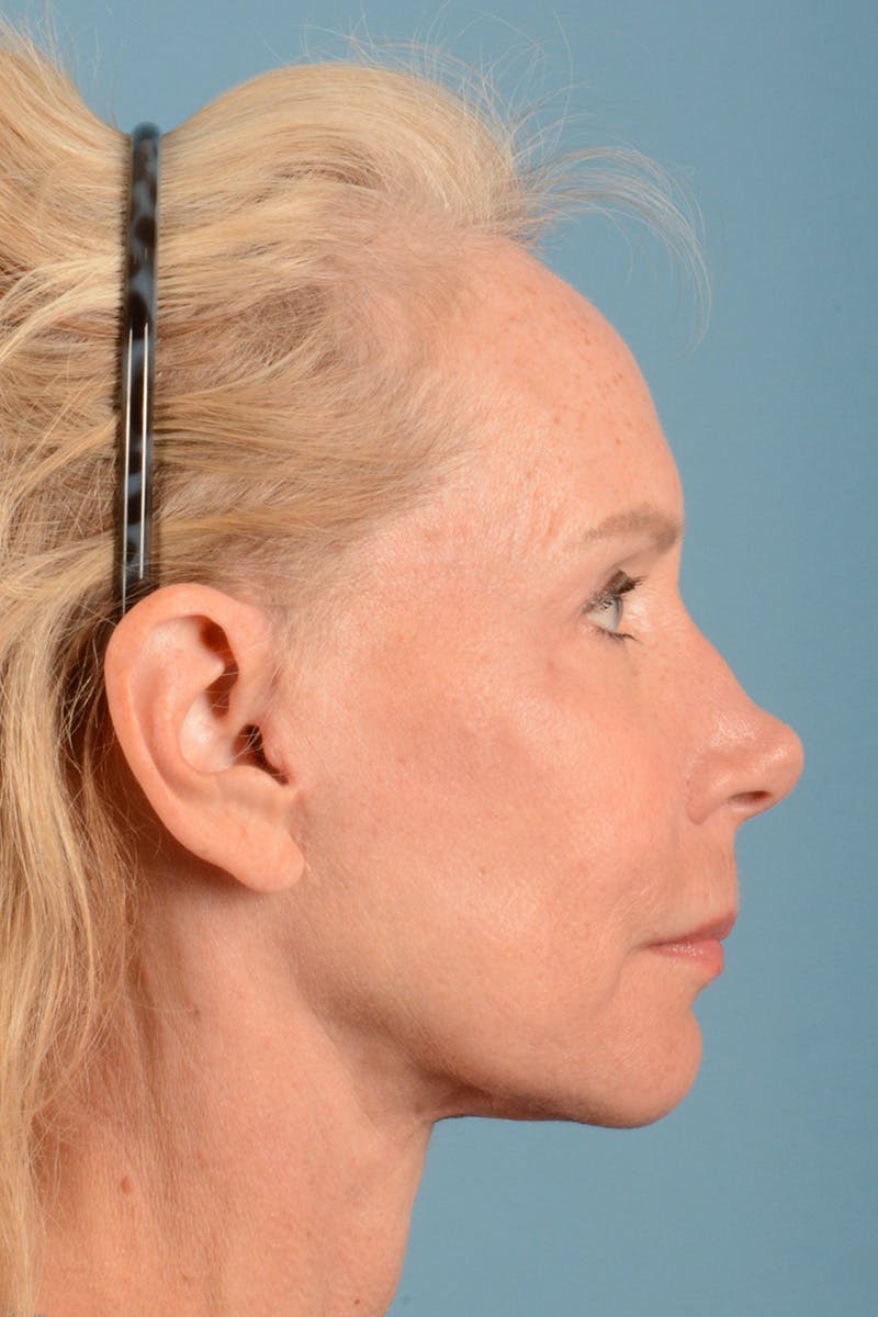Facelift Before & After Gallery - Patient 384471 - Image 6