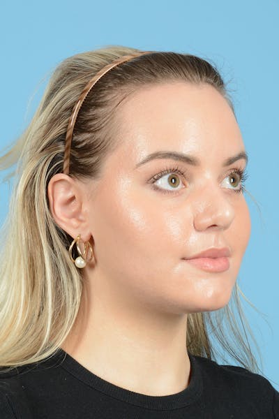 Rhinoplasty Before & After Gallery - Patient 214706 - Image 4