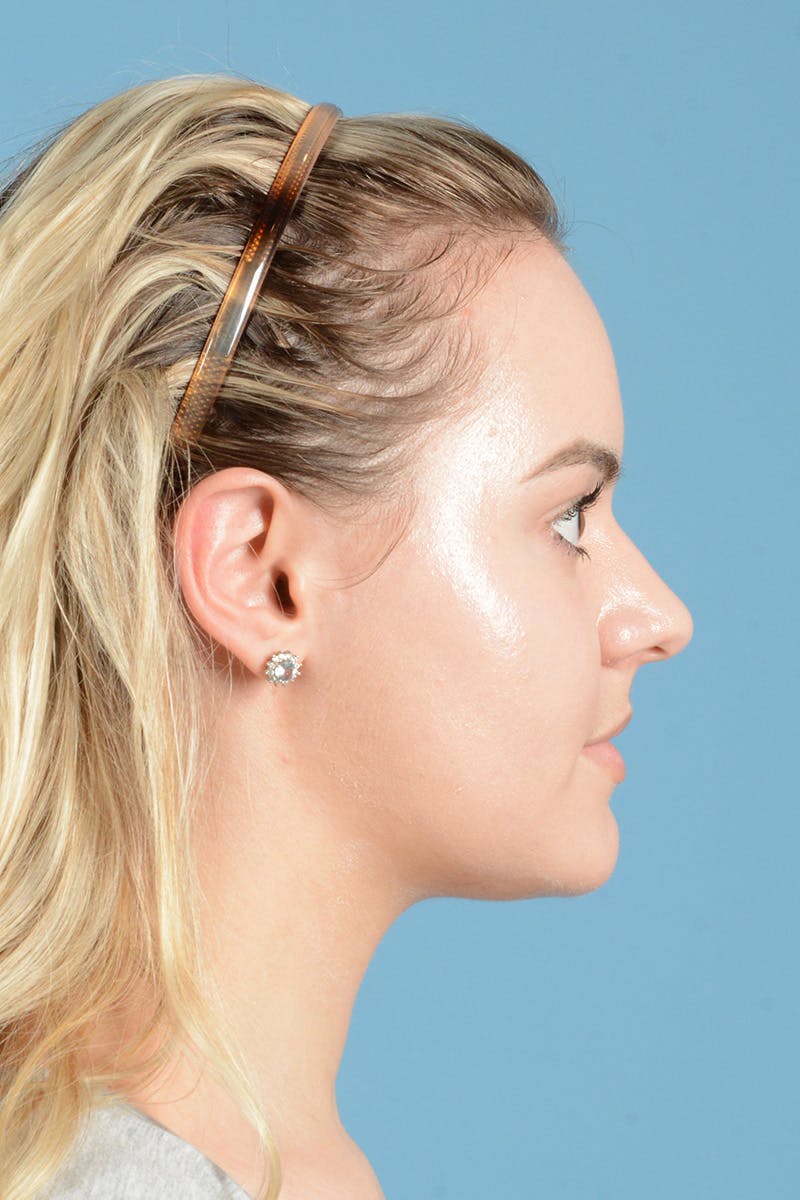 Rhinoplasty Before & After Gallery - Patient 214706 - Image 5
