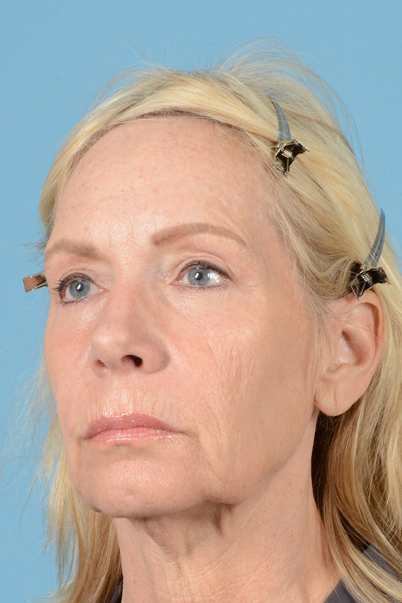 Facelift Before & After Gallery - Patient 384471 - Image 7
