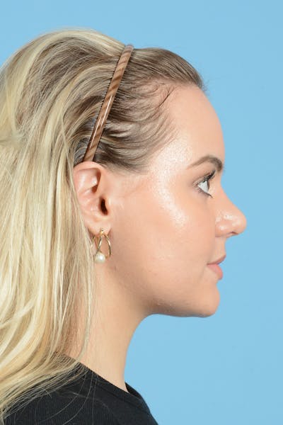 Rhinoplasty Before & After Gallery - Patient 214706 - Image 6