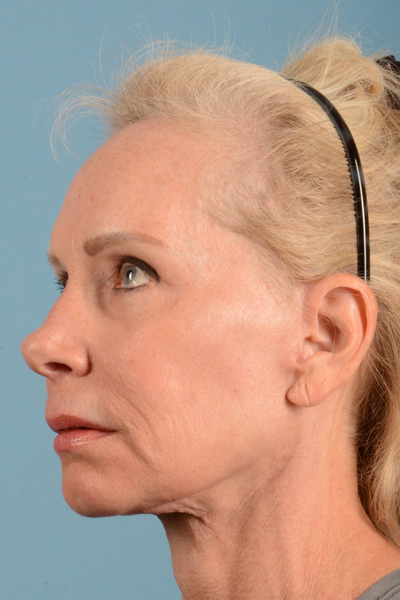 Facelift Before & After Gallery - Patient 384471 - Image 8