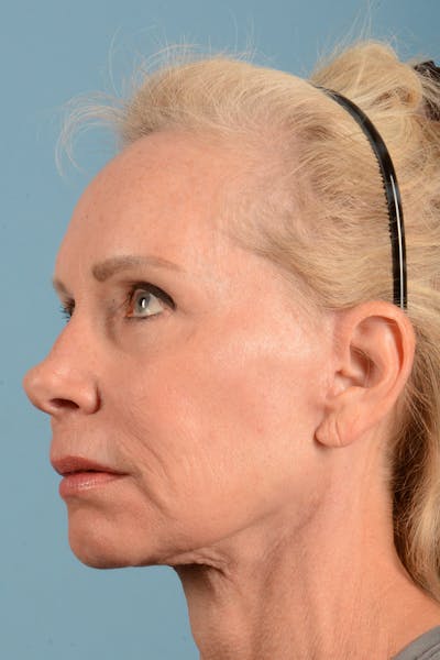 Facelift Before & After Gallery - Patient 384471 - Image 8