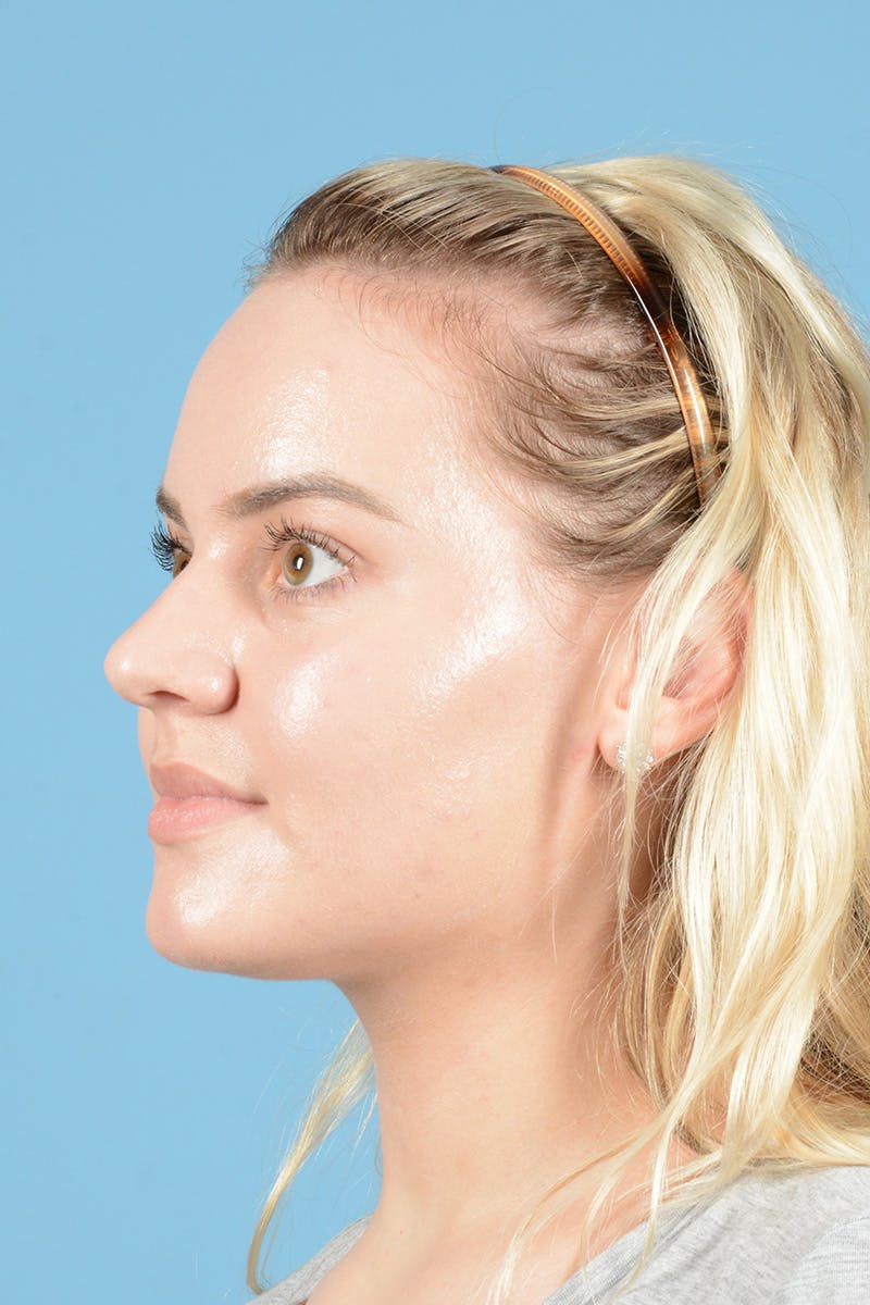 Rhinoplasty Before & After Gallery - Patient 214706 - Image 7