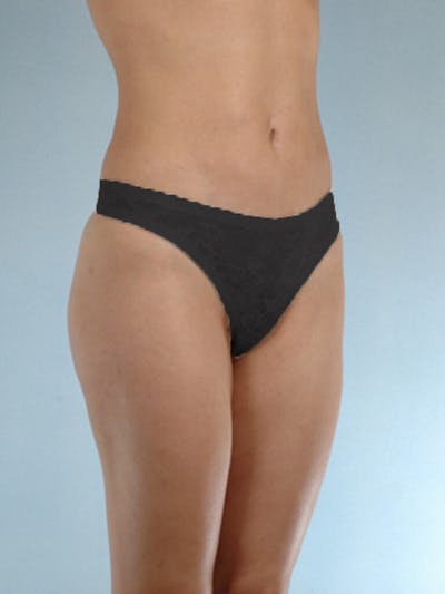 Liposuction Before & After Gallery - Patient 270910 - Image 6