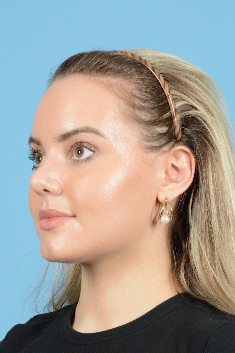 Rhinoplasty Before & After Gallery - Patient 214706 - Image 8
