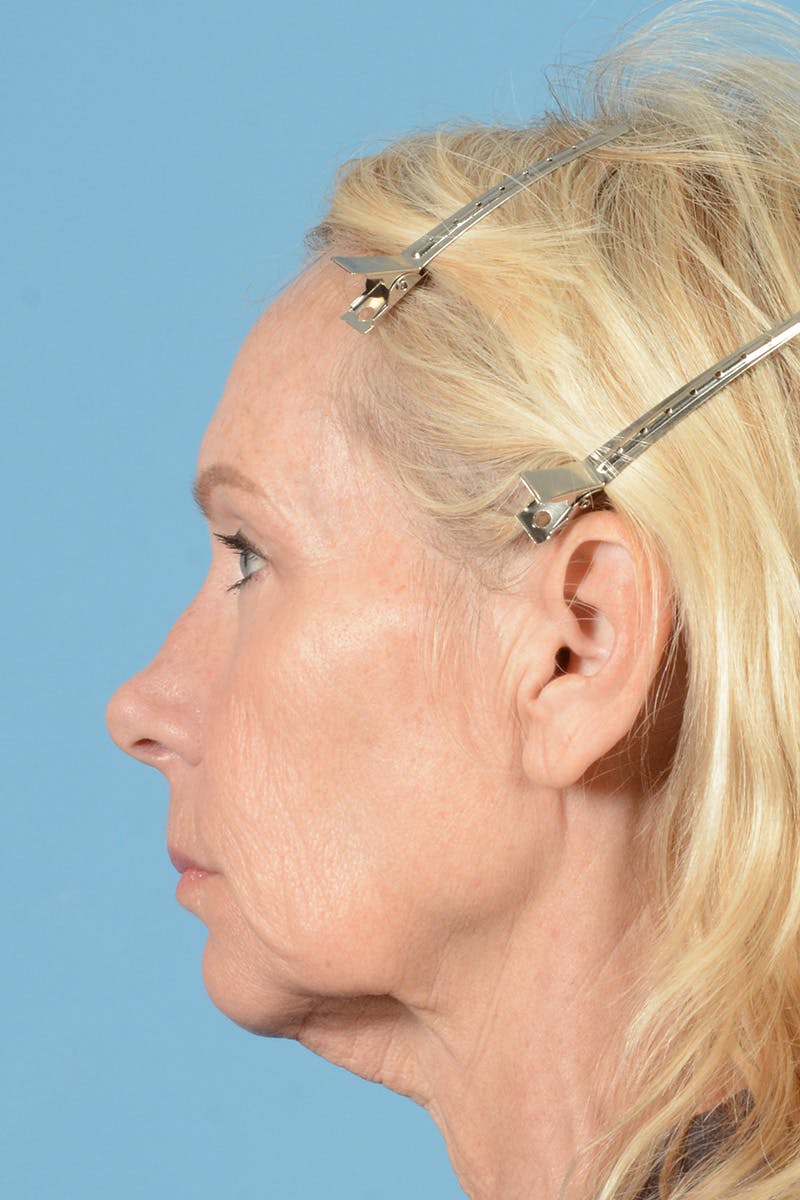 Facelift Before & After Gallery - Patient 384471 - Image 9