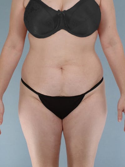 Tummy Tuck Before & After Gallery - Patient 263289 - Image 1
