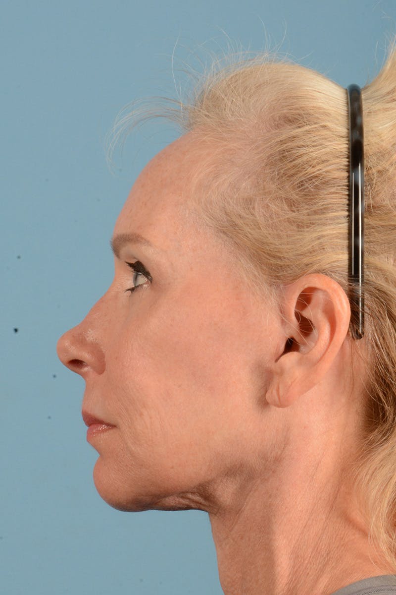 Facelift Before & After Gallery - Patient 384471 - Image 10