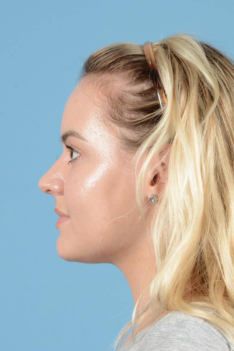 Rhinoplasty Before & After Gallery - Patient 214706 - Image 9
