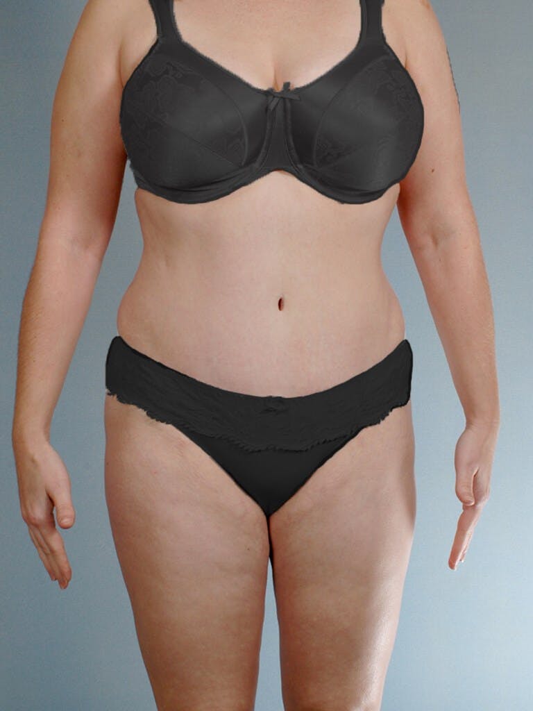 Tummy Tuck Before & After Gallery - Patient 263289 - Image 2