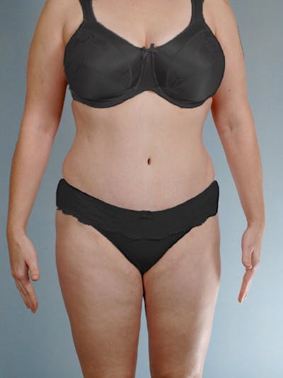 Tummy Tuck Before & After Gallery - Patient 263289 - Image 2