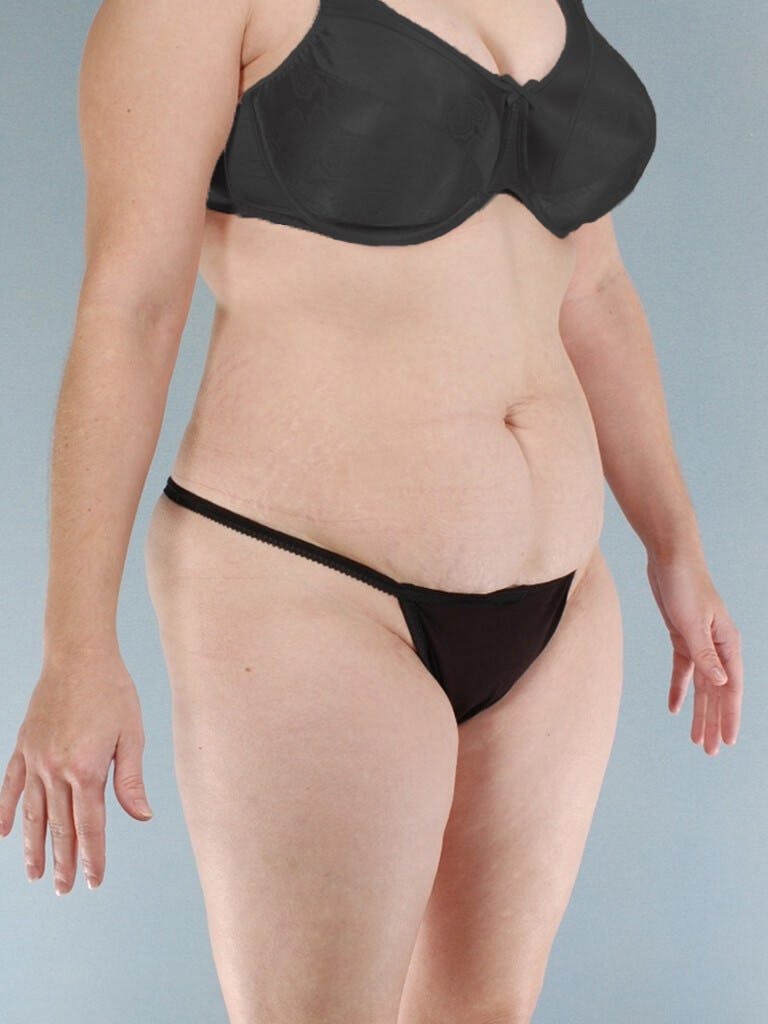 Tummy Tuck Before & After Gallery - Patient 263289 - Image 3