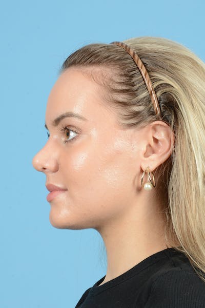 Rhinoplasty Before & After Gallery - Patient 214706 - Image 10