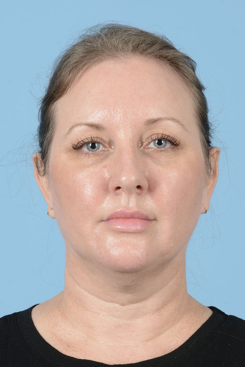 Facelift Before & After Gallery - Patient 443008 - Image 1