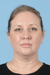 Facelift Before & After Gallery - Patient 443008 - Image 1